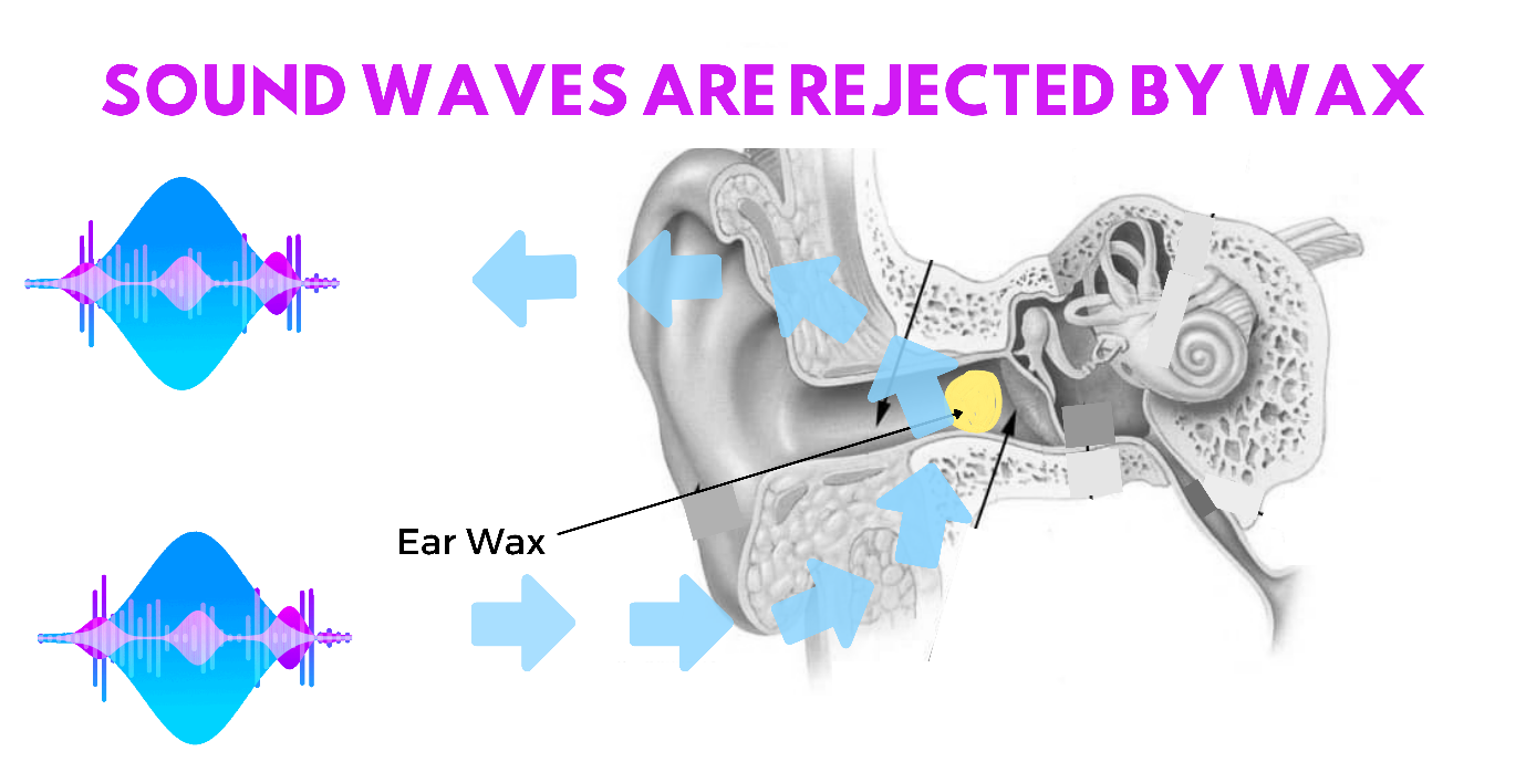 Diagram of how soundwaves are rejected by wax