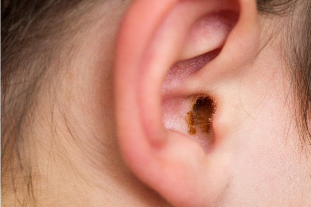 Closeup of ear with significant wax build up