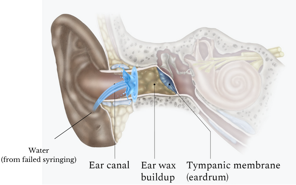 Inner ear diagram showing where wax can build up